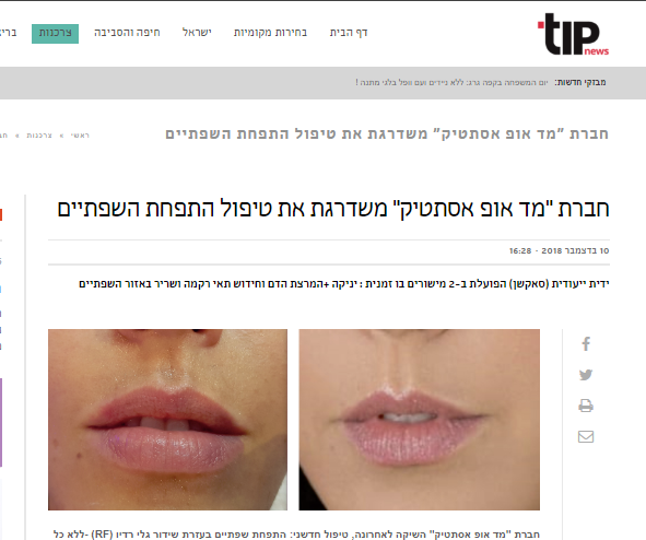 התפחה ועיבוי שפתיים של מד-אופ כתבה באתר 